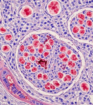 Understanding the histopathological features and microscopic findings in EGPA diagnosis.
