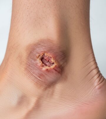 Comprehensive guide to causes, diagnosis, and management of chronic leg ulcers for optimal wound healing.