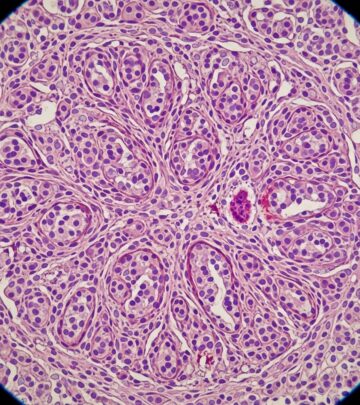 Understanding leiomyosarcoma pathology: histological features, immunohistochemical markers, and differential diagnosis.