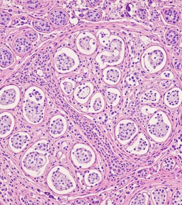 Exploring pseudocarcinomatous hyperplasia in anaplastic large cell lymphoma: pathology, mimics, and diagnostic challenges.